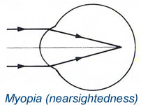 Myopia (nearsightedness)