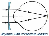 Myopia with corrective lenses