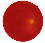 Healthy Retina