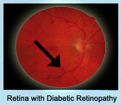 Retina with Diabetic Retinopathy